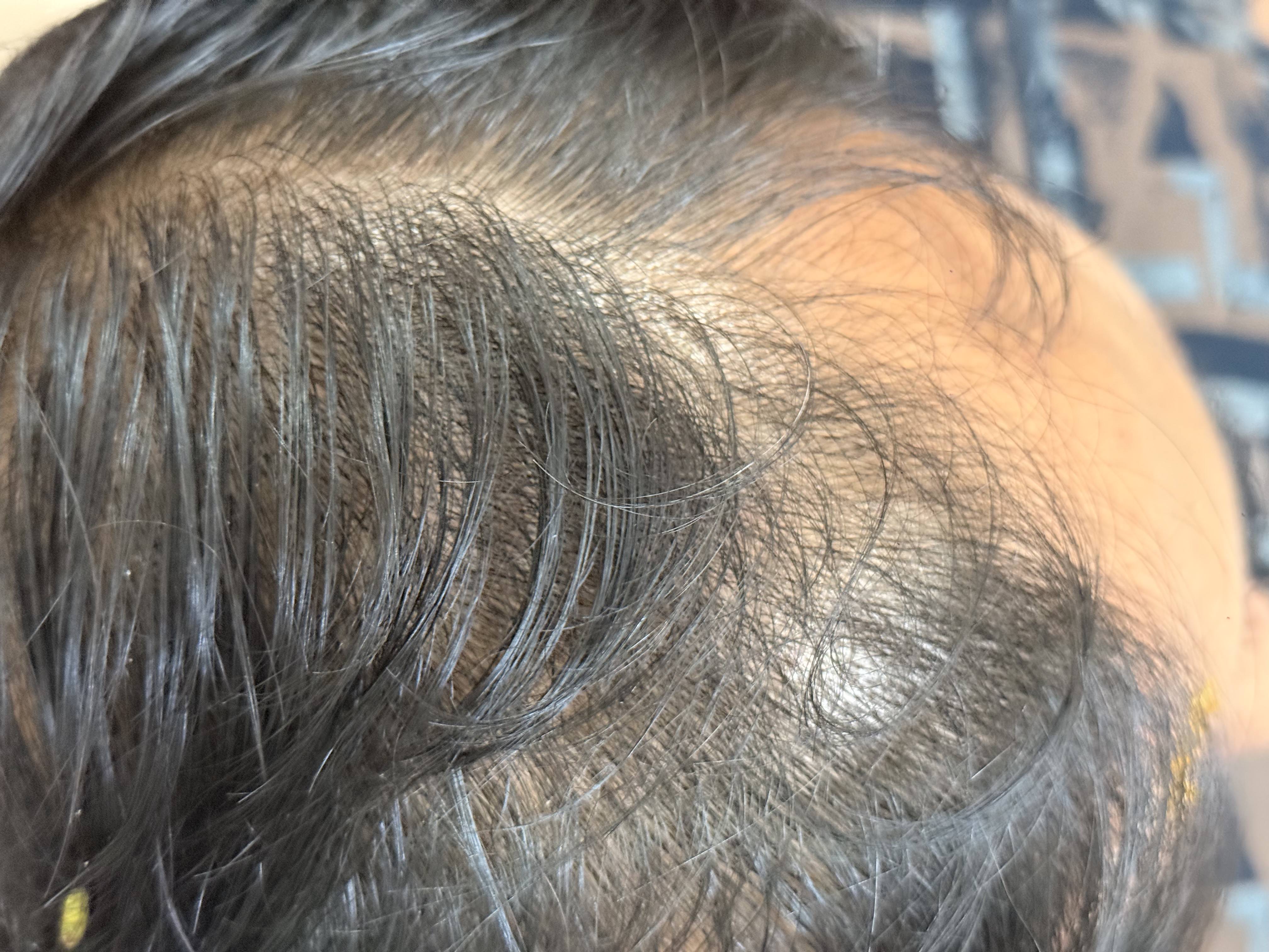 After Treatment